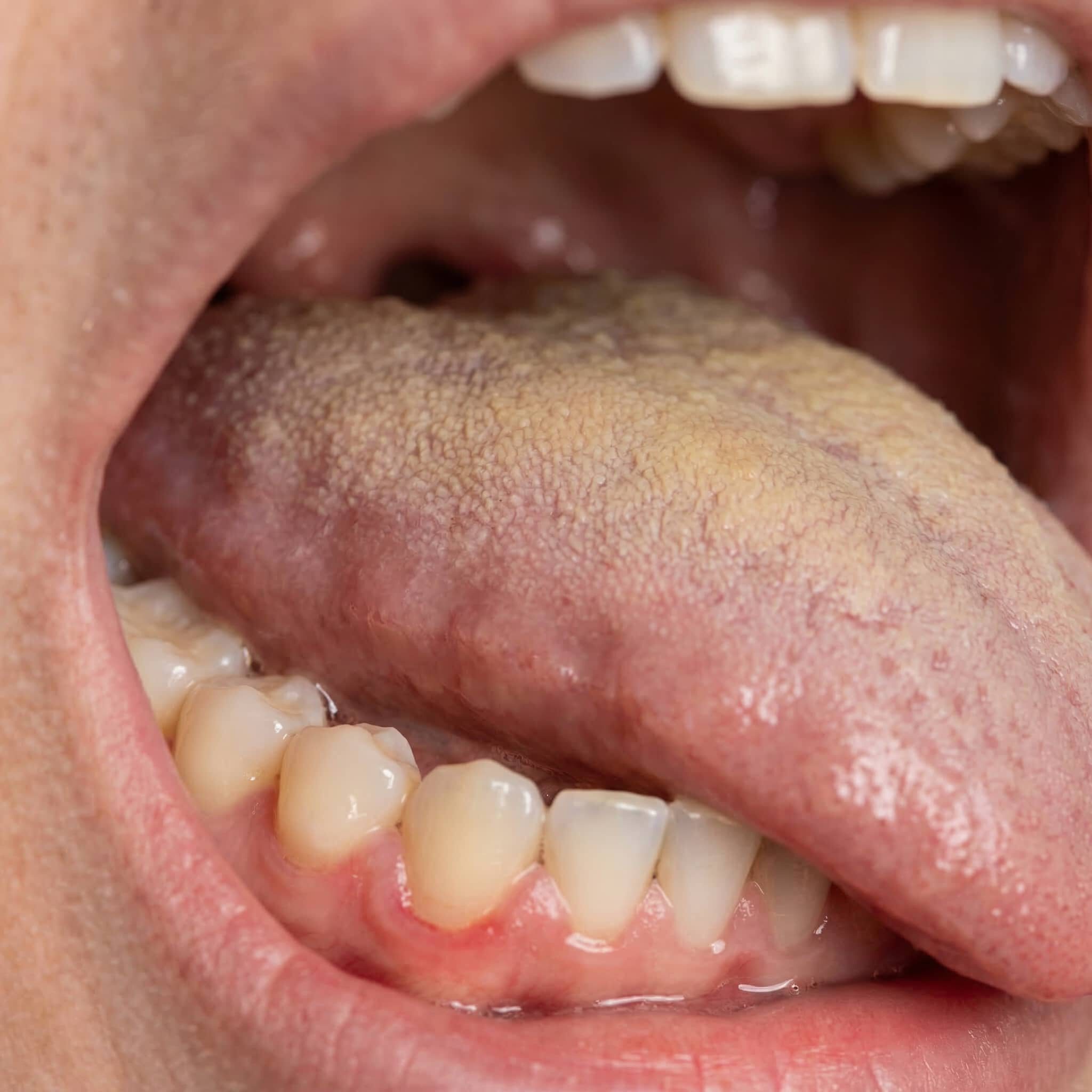 halitosis