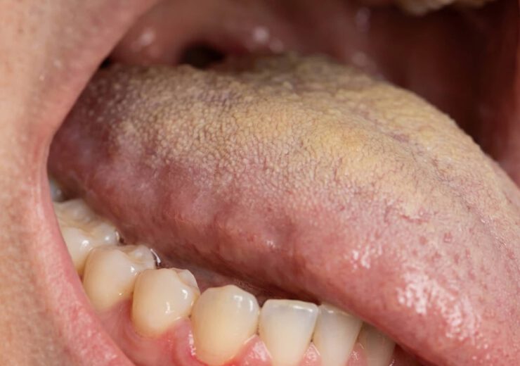 halitosis