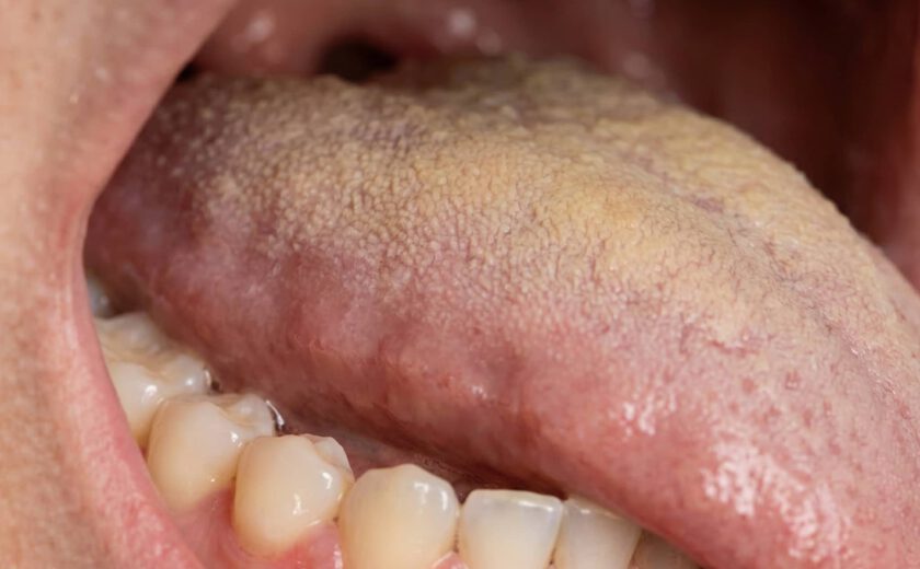 halitosis