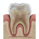 ¿Por qué se te quedan los dientes “sensibles” de repente? Cómo identificar la hipersensibilidad dental y qué hacer